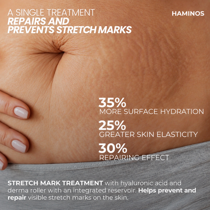 Stretch Marks Kit — Derma Roller + Hyaluronic Acid Serum