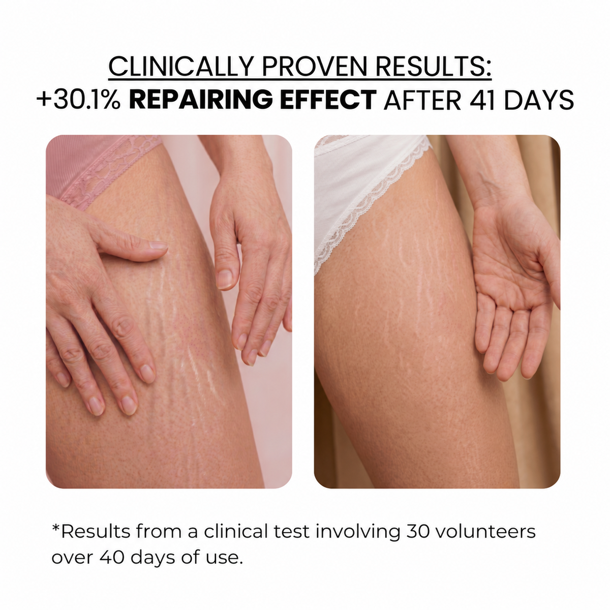Stretch Marks Kit — Derma Roller + Hyaluronic Acid Serum