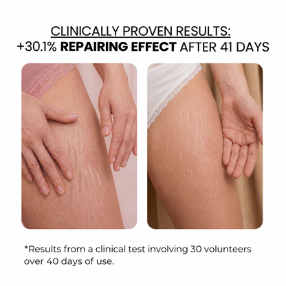 Stretch Marks Kit — Derma Roller + Hyaluronic Acid Serum