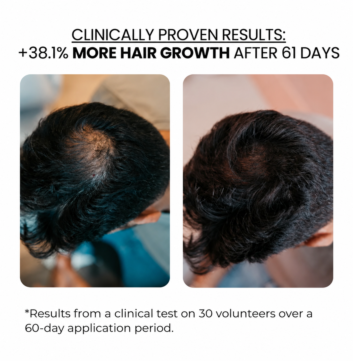 Hair & Beard Kit — Derma Roller + Hair & Beard Serum