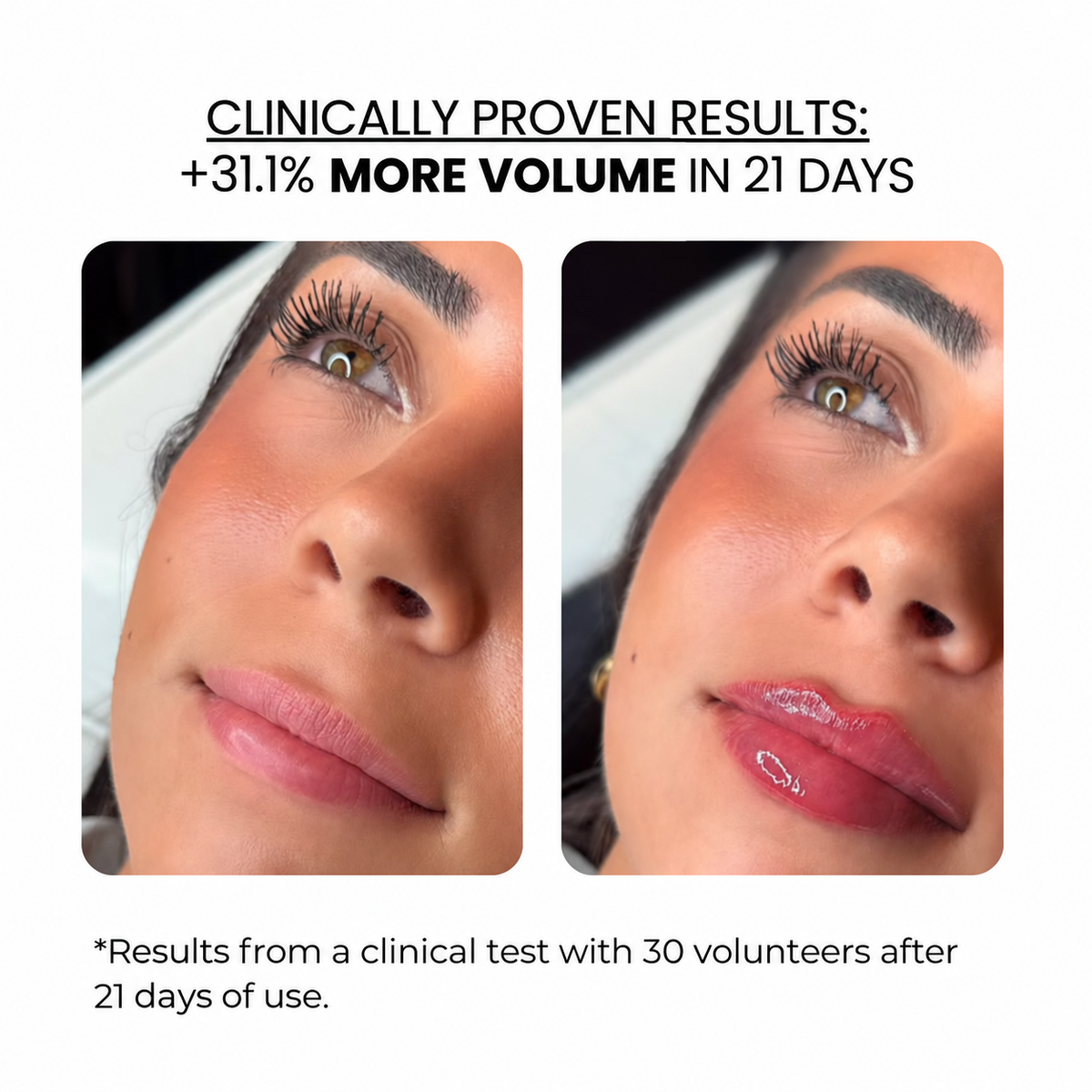 Lip Treatment Kit — Derma Roller + Hyaluronic Acid Serum