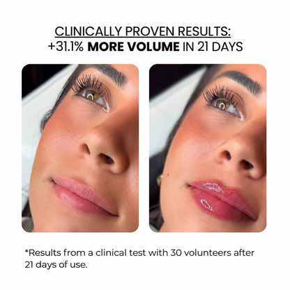 Lip Treatment Kit — Derma Roller + Hyaluronic Acid Serum