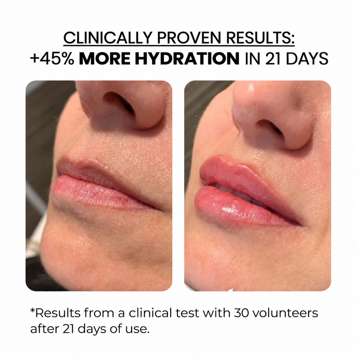 Lip Treatment Kit — Derma Roller + Hyaluronic Acid Serum