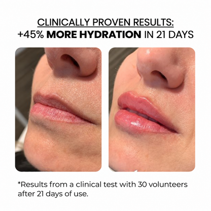 Lip Treatment Kit — Derma Roller + Hyaluronic Acid Serum
