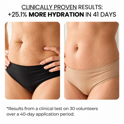Stretch Marks Kit — Derma Roller + Hyaluronic Acid Serum